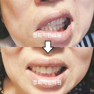 전후사진 이미지1