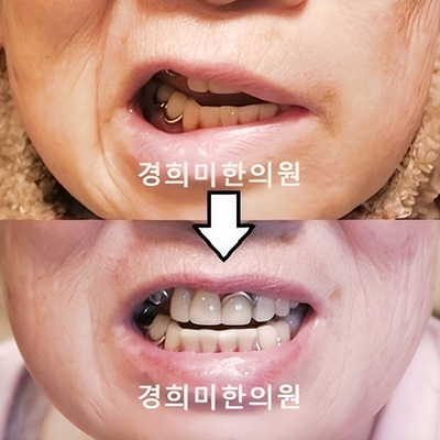 전후사진 이미지2