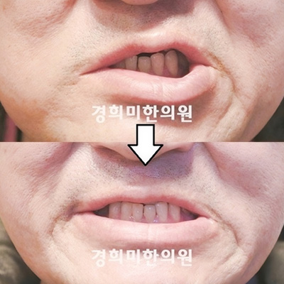 전후사진 이미지3