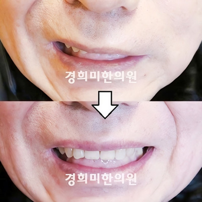 전후사진 이미지9
