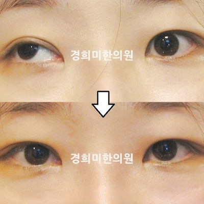 전후사진 이미지1