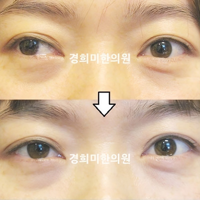 전후사진 이미지2