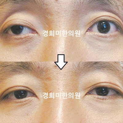 전후사진 이미지3