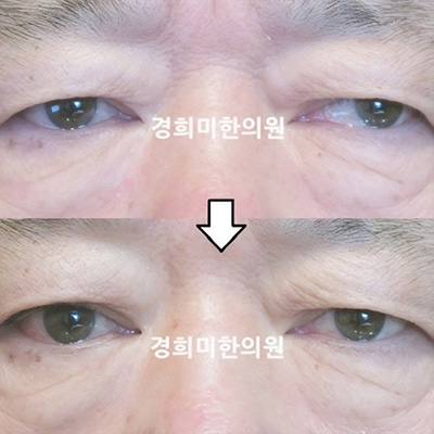 전후사진 이미지6