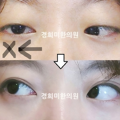 전후사진 이미지3