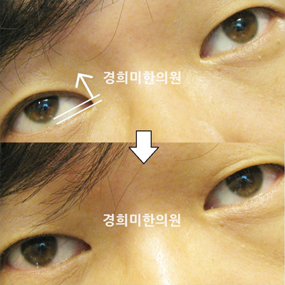 전후사진 이미지6