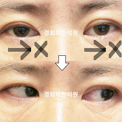 전후사진 이미지8