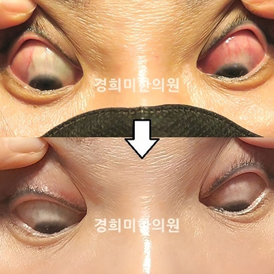 전후사진 이미지1