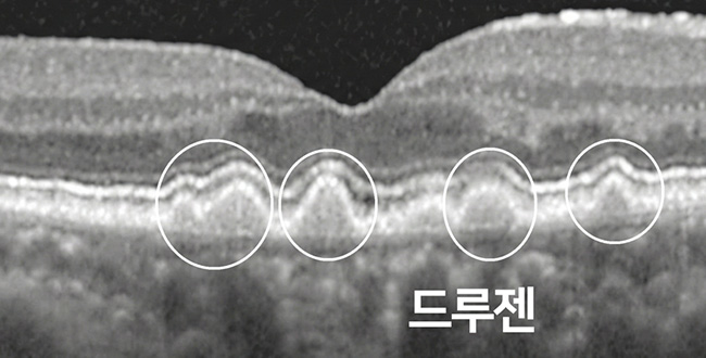 증상 이미지2