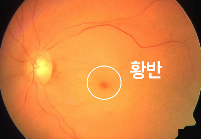 증상 이미지4