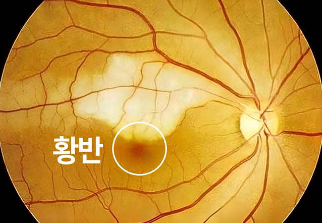 증상 이미지5