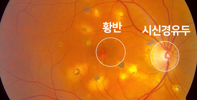 증상 이미지5
