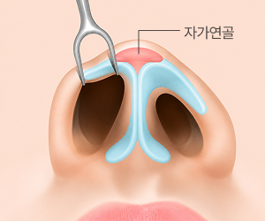 자가연골 삽입
