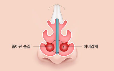 하비갑개 비대증