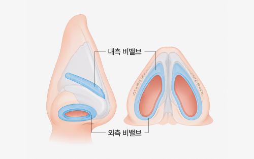 비밸브 수술