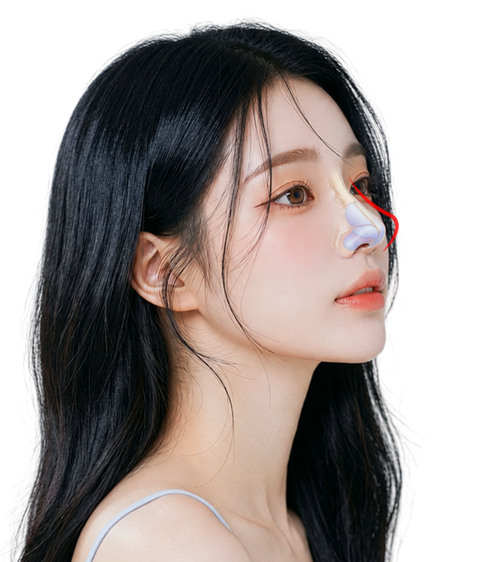 골절 치료 모델 이미지