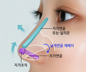 코끝 지지 구조 보강