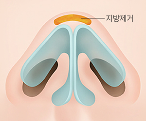 코끝 지방 제거