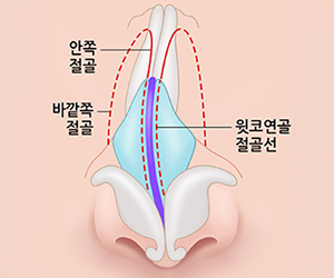 코 안쪽과 바깥쪽 절골