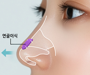 회전이식술 시행
