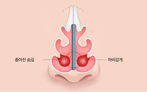 만성비염 · 알레르기성 비염