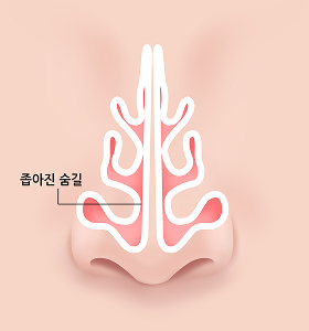 비갑개 축소술 전