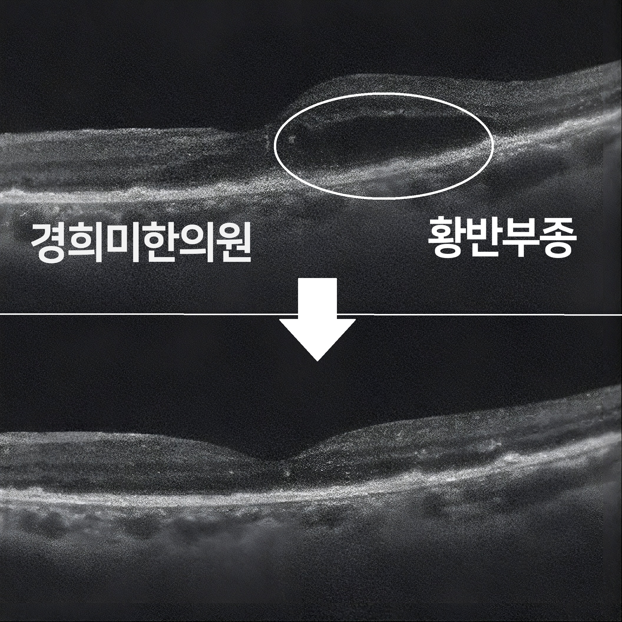 1-황반변성 배영숙(좌안).jpg