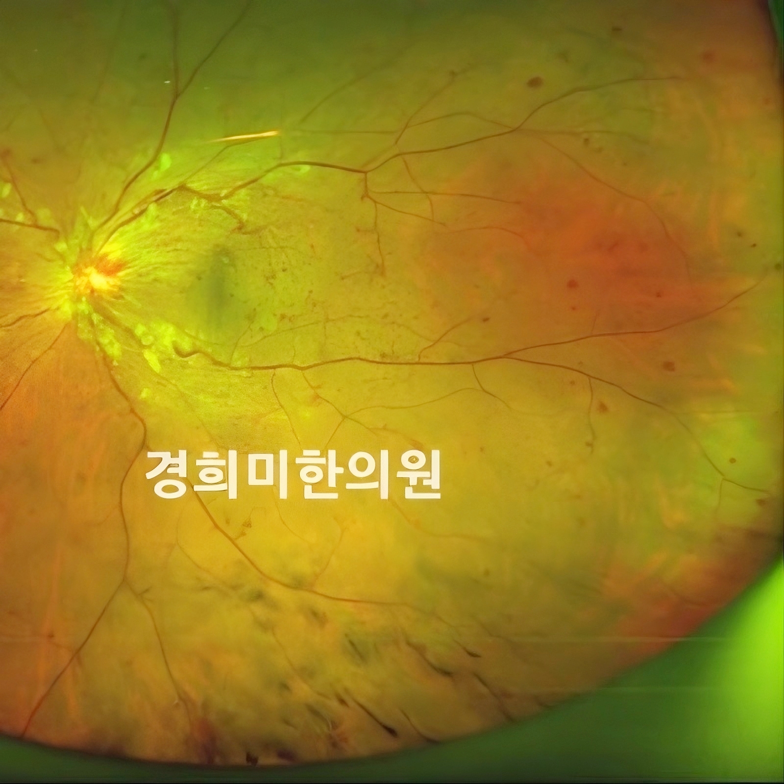 4-망막정맥폐쇄 김동만1(좌안).jpg