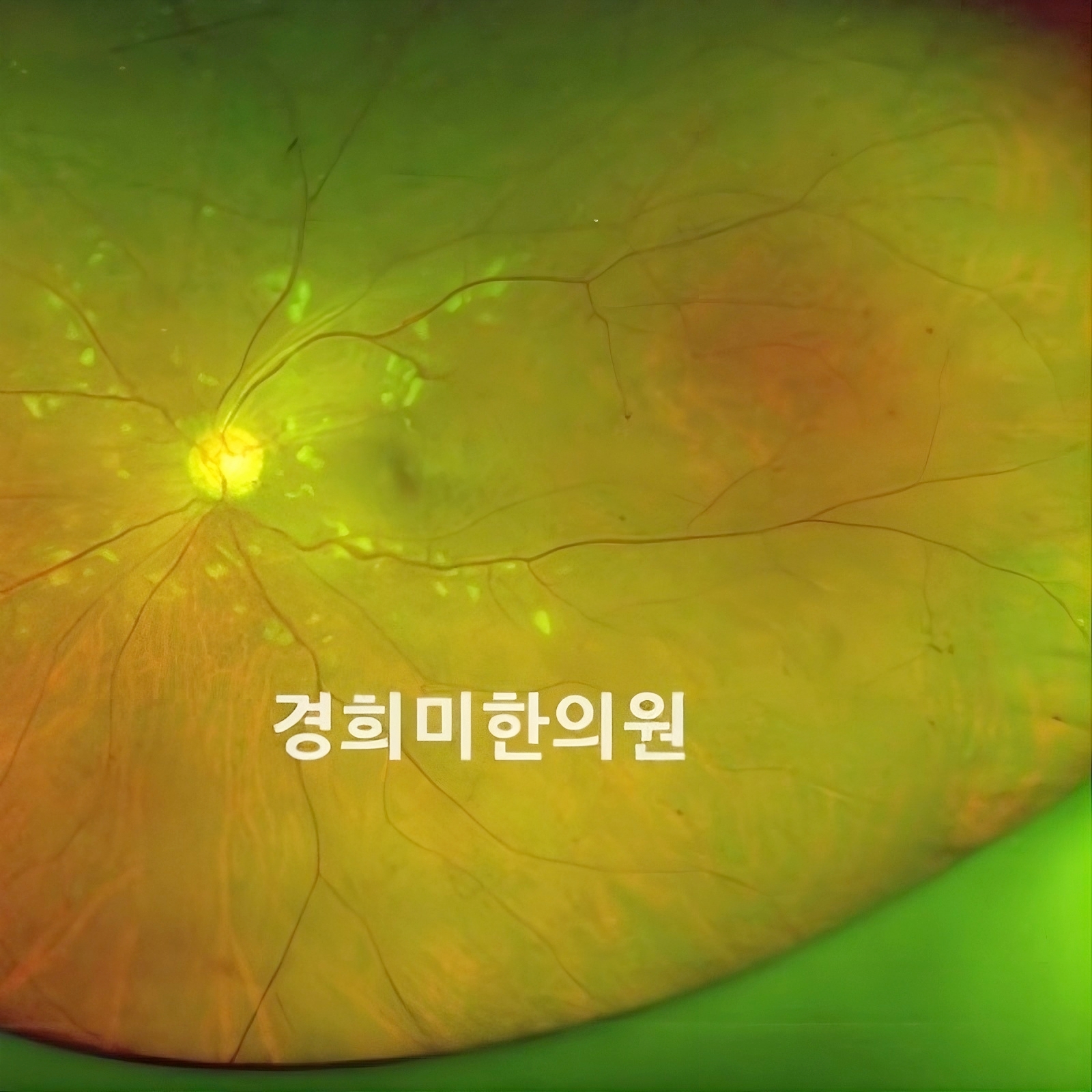 4-망막정맥폐쇄 김동만2(좌안).jpg