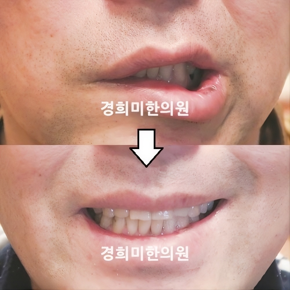 10번-15048(2차발병).jpg