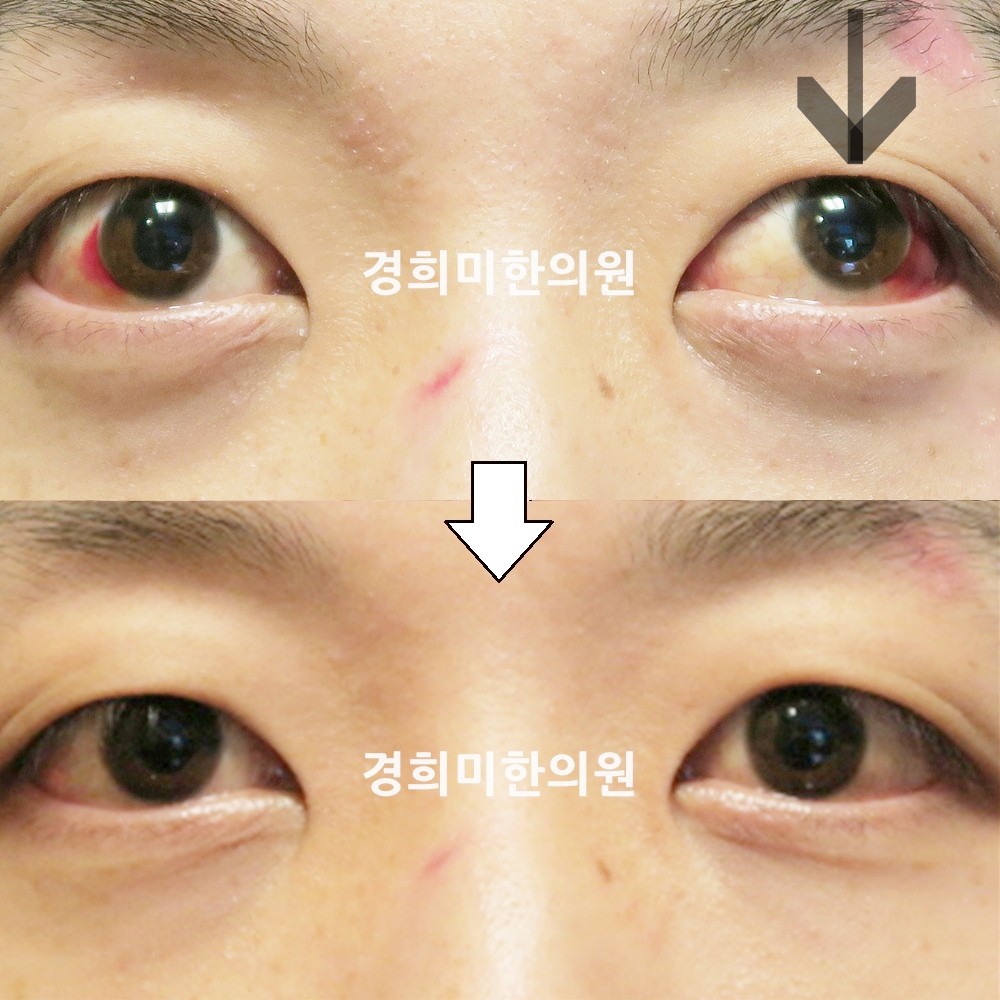 70번-15503-강강약-표시.jpg