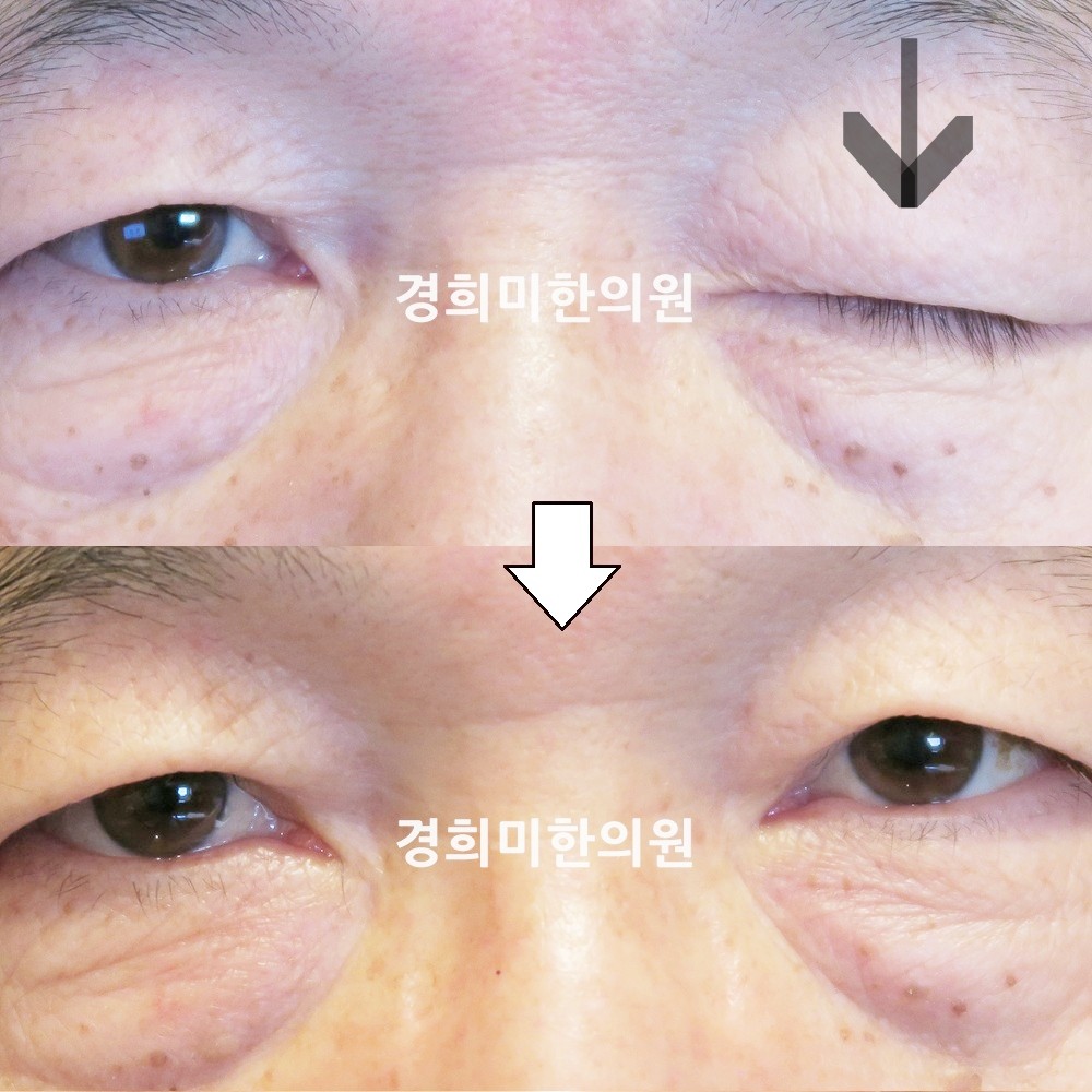 96번-17332-강강약-표시.jpg