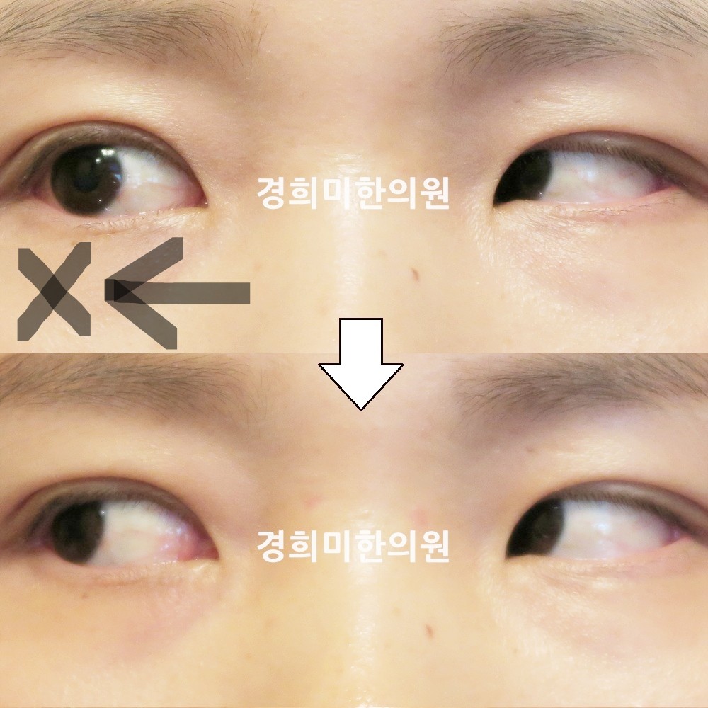 104번-17913-강강약-표시.jpg